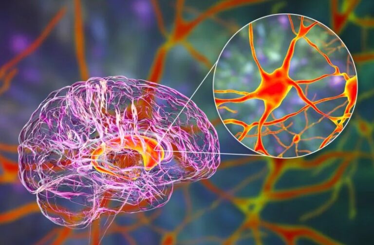 One-Time Gene Therapy Shows Lasting Promise Against Huntington’s Disease Four Years Later